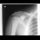 Acromioclavicular dislocation, osteosynthesis: X-ray - Plain radiograph